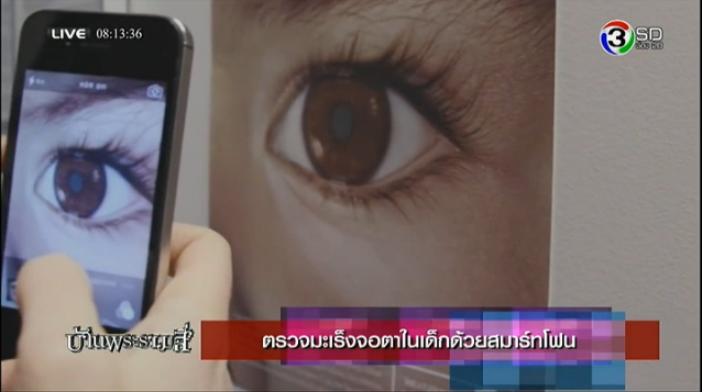 ตรวจมะเร็งจอตาในเด็กด้วย SmartPhone